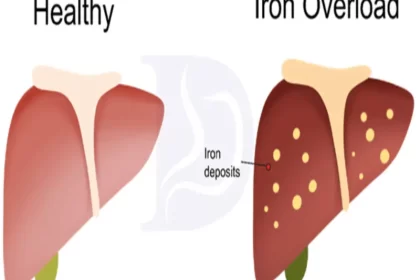 بیماری هموکروماتوز