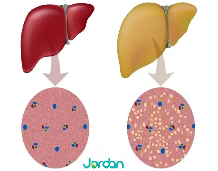 بیماری هموکروماتوز